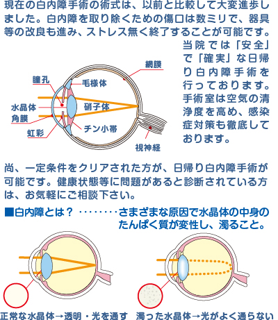 現在の白内障手術の術式は、以前と比較して大変進歩しました。白内障を取り除くための傷口は数ミリで、器具等の改良も進み、ストレス無く終了することが可能です。当院では「安全」で「確実」な日帰り白内障手術を行っております。手術室は空気の清浄度を高め、感染症対策も徹底しております。
尚、一定条件をクリアされた方が、日帰り白内障手術が可能です。健康状態等に問題があると診断されている方は、お気軽にご相談下さい。
■白内障とは？ ‥‥‥‥さまざまな原因で水晶体の中身のたんぱく質が変性し、濁ること。
正常な水晶体→透明・光を通す
濁った水晶体→光がよく通らない